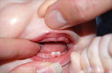 Bé hay chảy máu chân răng: dấu hiệu bệnh nguy hiểm?